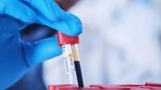 Учени разработиха революционен тест за рак на простатата