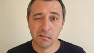 Невролог обяснява кои са първите симптоми на фациалис преди изкривяване на лицето