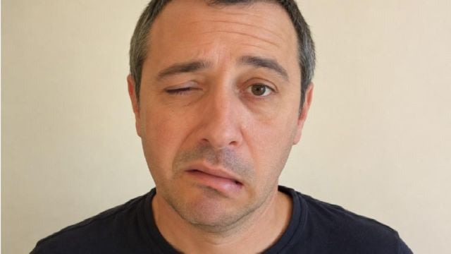 Невролог обяснява кои са първите симптоми на фациалис преди изкривяване на лицето
