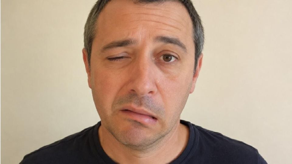 Невролог обяснява кои са първите симптоми на фациалис преди изкривяване на лицето