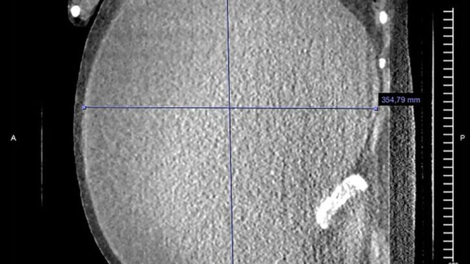 Жена си мислеше, че просто е напълняла, докторите обаче й сложиха страшна диагноза