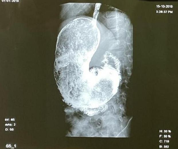 Шок: Не е за вярване какво откриха в стомаха на здраво 11-г. момченце СНИМКИ 18+