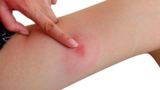 Месеци на мъки: Жена видя "плътта и мъртвите си тъкани" след мистериозно ухапване в бар