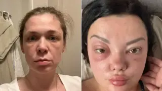 Кошмар след инжекция: Десетки жени обезобразени от нов филър, лекарите са в ужас и разперват ръце