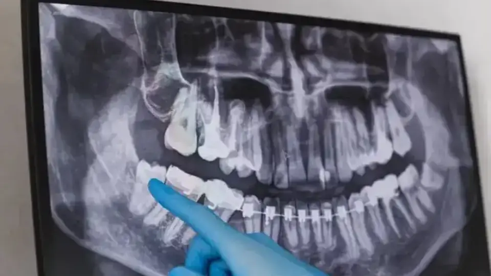 Шок на зъболекарския стол: Рентгенът на 13-годишно момиче разкри метална тайна, пазена половин година