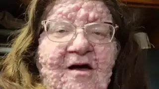 Ад на Земята: Майка с над 200 тумора по лицето и тялото