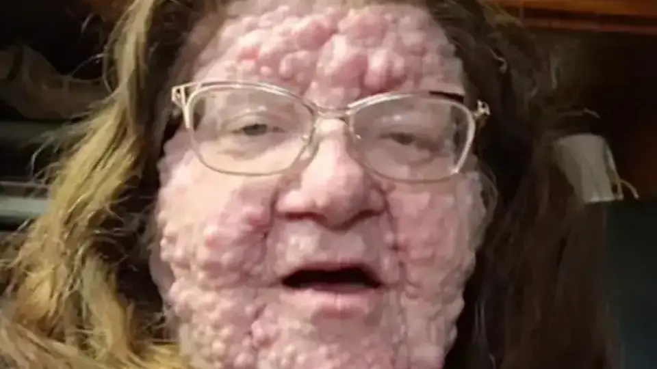 Ад на Земята: Майка с над 200 тумора по лицето и тялото