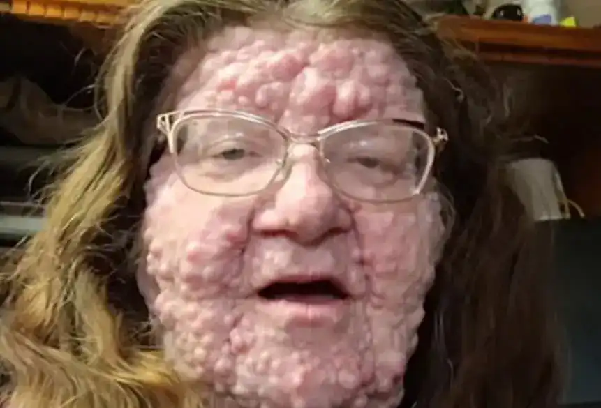 Ад на Земята: Майка с над 200 тумора по лицето и тялото