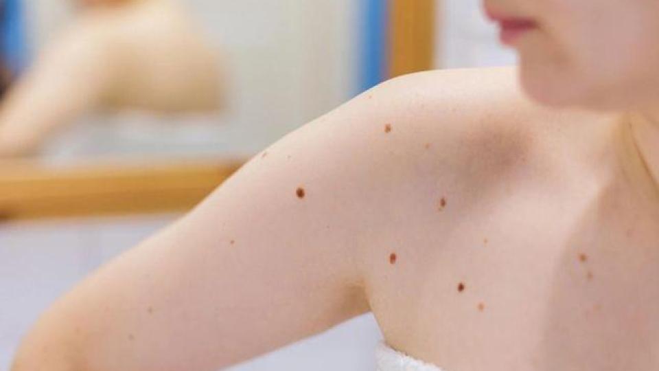 Печат на Съдбата: Хората с такива бенки имат специална мисия