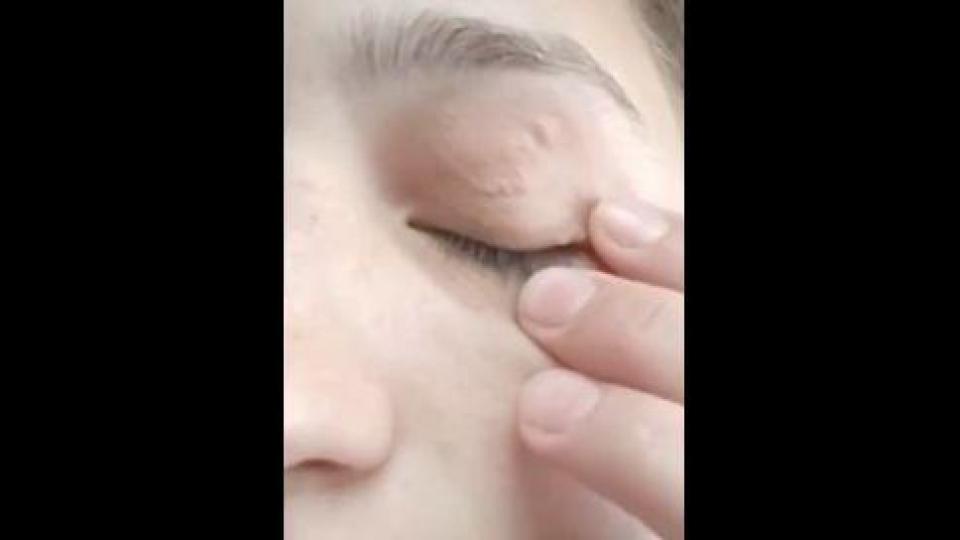 Червей се излюпи в челото на жена, пропълзя в окото й и... Видео
