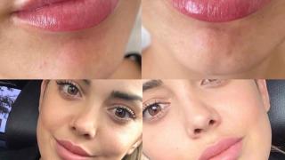 ARMADA LIPS™: Когато естествените и хармонични устни са новият стандарт в естетиката