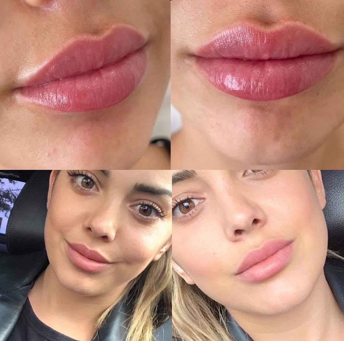 ARMADA LIPS™: Когато естествените и хармонични устни са новият стандарт в естетиката