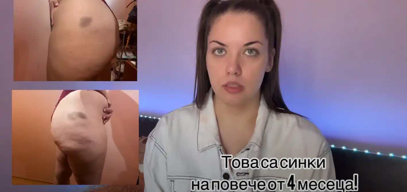 Веселка от "Биг Брадър" с разтърсващи разкрития за клиника в Турция след операция за отслабване Видео