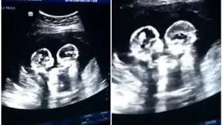 Любима двойка от "Един за друг" очаква близнаци