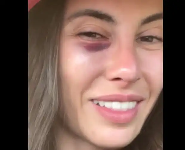 Звезда от "Игри на волята" се появи с посинено око Видео