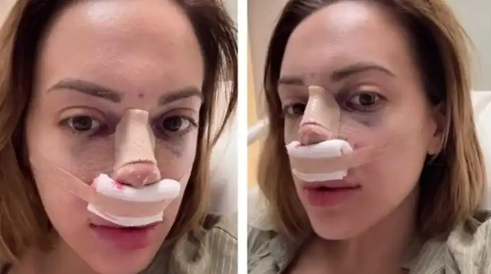 Ергенката Анна-Мария си клъцна носа Снимки