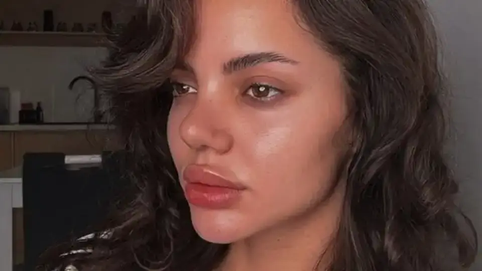 Ергенката Валерия Дакова показа новия си нос 14 дни след операцията Снимки