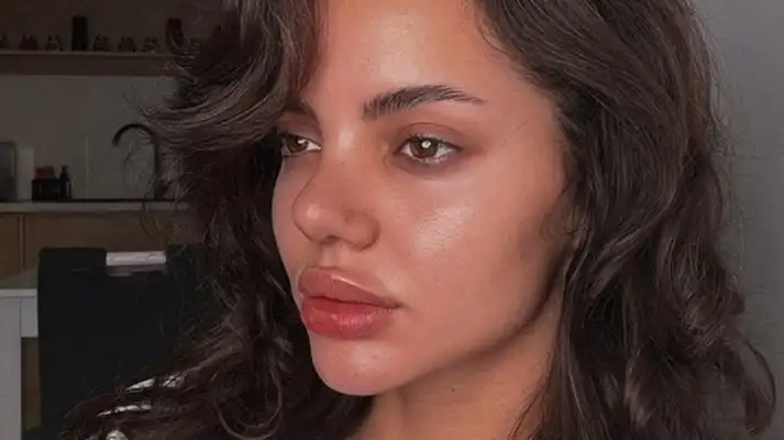 Ергенката Валерия Дакова показа новия си нос 14 дни след операцията Снимки