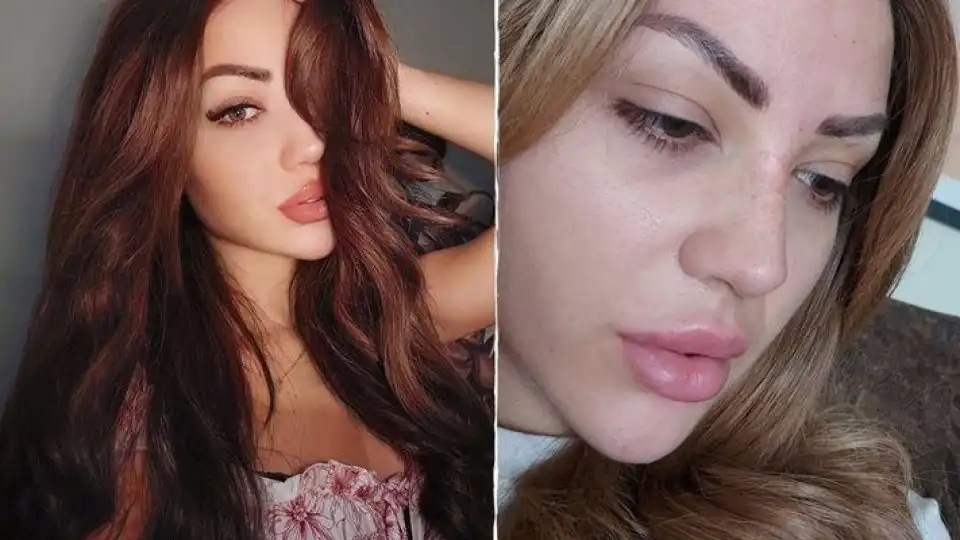 Ергенка на косъм от смъртта след ужилване от...